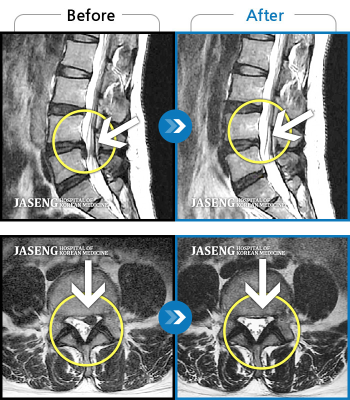 수원자생한방병원 치료사례 MRI로 보는 치료결과-좌측 엉덩이부터 종아리까지 저림 및 통증