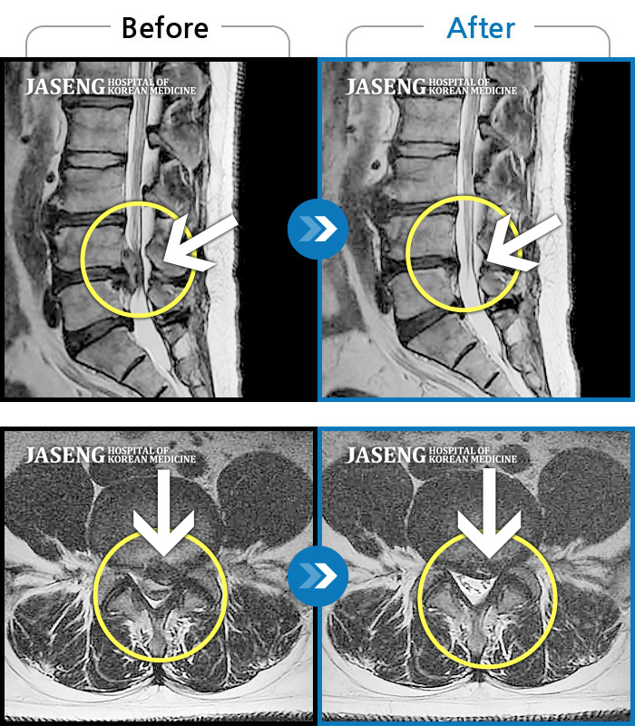 수원자생한방병원 치료사례 MRI로 보는 치료결과-우측 허리 골반 통증과 우측 다리 방사통, 우측 다리 감각 둔화