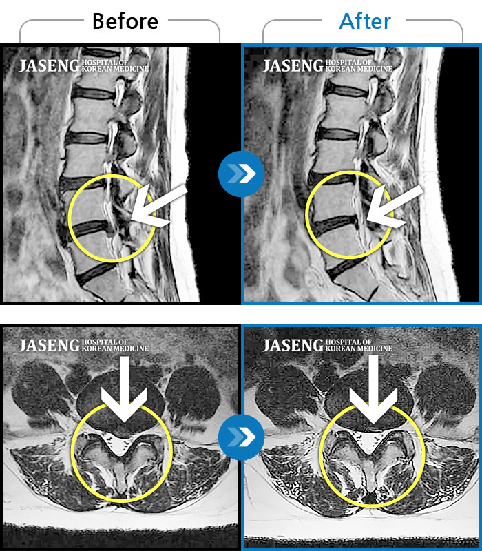 수원자생한방병원 치료사례 MRI로 보는 치료결과-좌측 허리 골반 통증과 좌측 다리 방사통으로 응급으로 내원