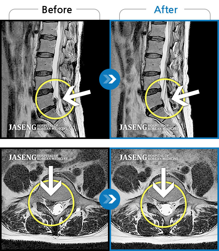 수원자생한방병원 치료사례 MRI로 보는 치료결과-허리 통증과 우측 고관절~하지방사통이 심하여 활동하기 힘든 상태