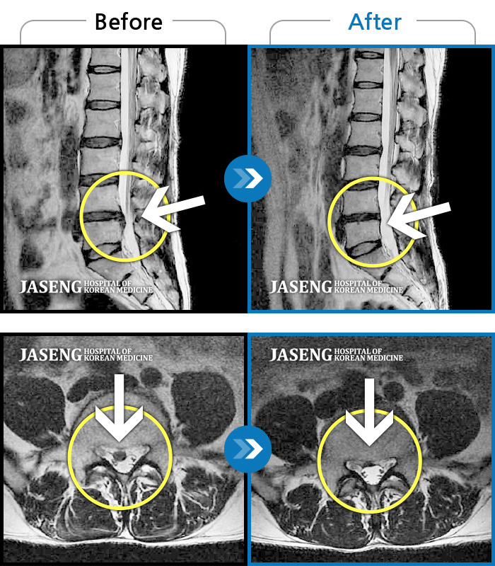 수원자생한방병원 치료사례 MRI로 보는 치료결과-우측 허리 통증과 우측 다리 방사통으로  활동하기 힘든 상태