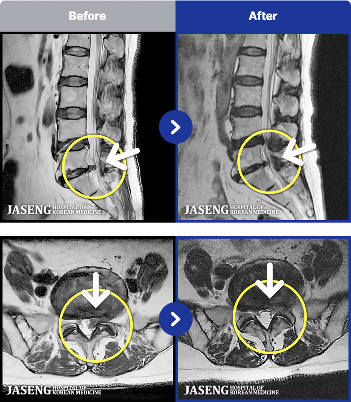 �ڻ��ѹ溴�� ġ���� MRI�� ���� ġ����-�㸮, ���� ��ݺ��� ���� �ٸ����� ���� �� ������ ���ӵǰ�, �㿡 �� �� ���� �ٸ��� �㰡 ���� ���� �� ���� ������ �� ��ȭ�Ǵ� ����� ȣ���ϴ� ���¿����ϴ�.