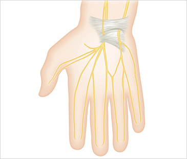 수원자생한방병원 기타관절질환 손목터널증후군-손목터널증후군에 관련된 이미지 입니다.