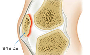 수원자생한방병원 무릎질환 슬개골연골연화증-슬개골 연골이 위치해 있는 무릎 설명 이미지