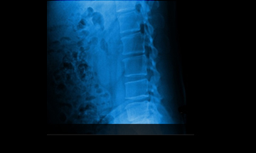 수원자생한방병원 허리질환 척추후만증-척추후만증에 관련된 이미지 입니다.