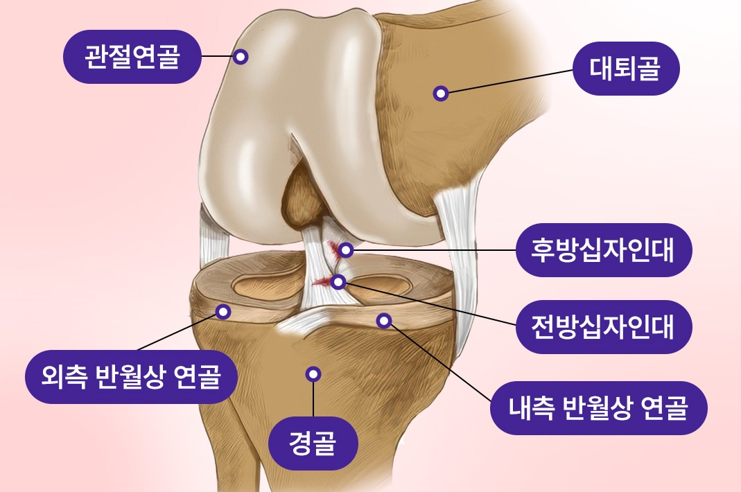 무릎 관절의 인대 구조와 손상 부위를 표시한 일러스트