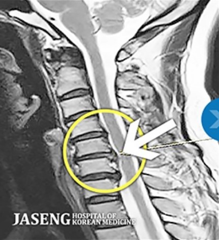 자생 비수술 한방통합치료 전 MRI 비교 이미지